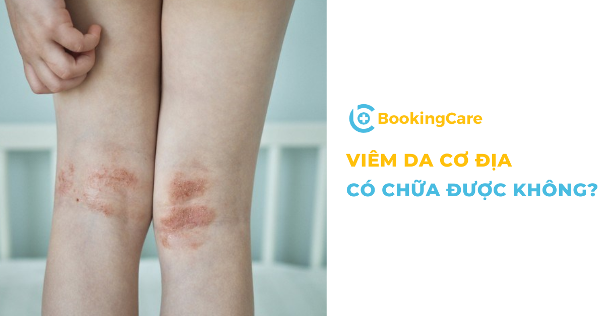 Viêm da cơ địa có chữa được không?